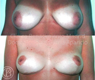 imagen de caso real antes y despues reduccion de senos clinica renacimiento madrid 15