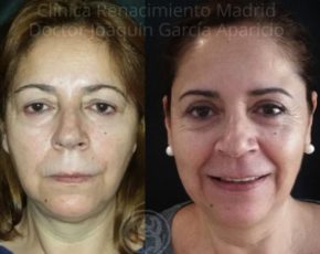 imagen de casos blefaroplastia antes y despues clinica renacimiento madrid
