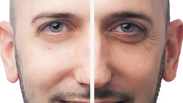 imagen de casos reales corrección de arrugas clinica renacimiento madrid