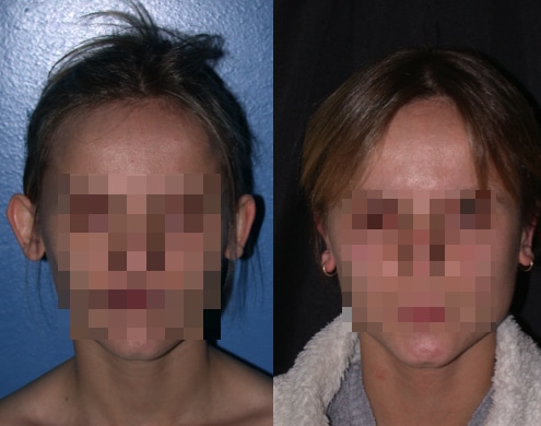 imagen de cirugia de OREJA otoplastia antes y despues clinica renacimiento madrid 4