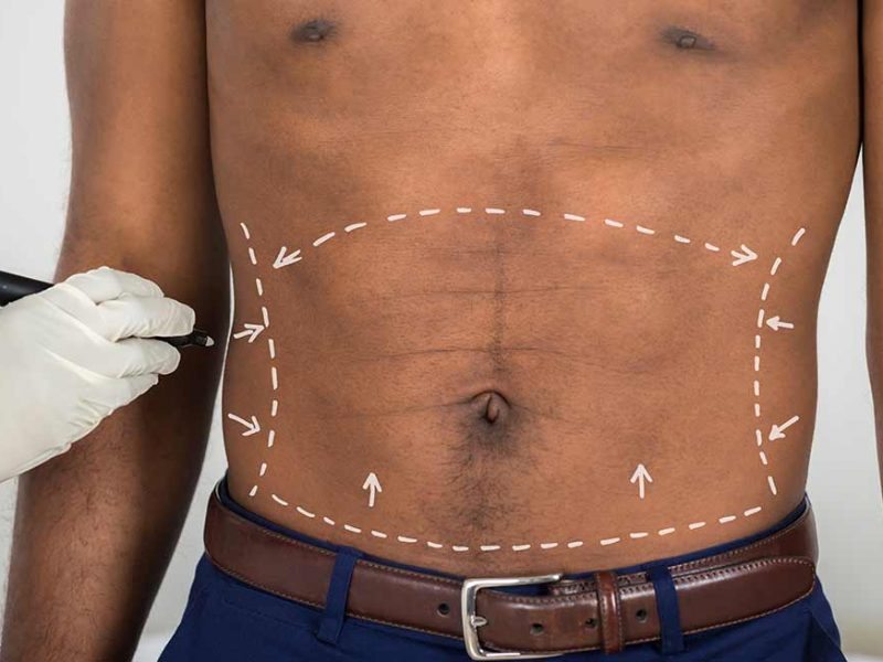 cirugia de abdomen hombre abdominoplastia