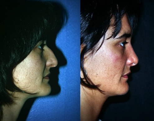 imagen de cirugia de nariz rinoplastia antes y despues clinica renacimiento madrid 2