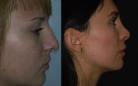imagen de cirugia de nariz rinoplastia antes y despues clinica renacimiento madrid 3