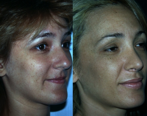 imagen de cirugia de nariz rinoplastia antes y despues clinica renacimiento madrid 5