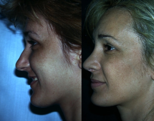 imagen de cirugia de nariz rinoplastia antes y despues clinica renacimiento madrid 9