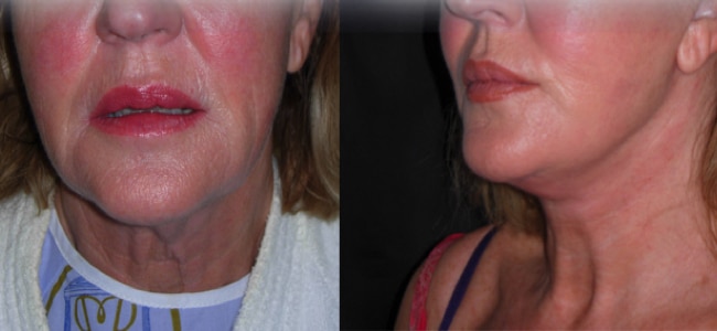 imagen de clinica renacimiento madrid lifting de cuello caso real antes y despues 1