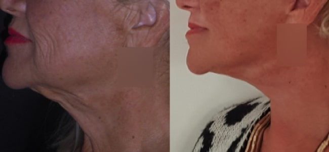 imagen de clinica renacimiento madrid lifting de cuello caso real antes y despues 3