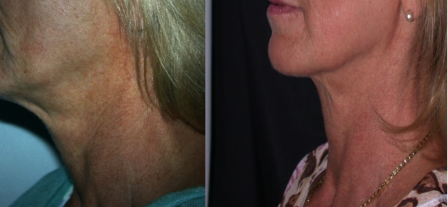 imagen de clinica renacimiento madrid rejuvenecimiento de cuello caso real antes y despues 3