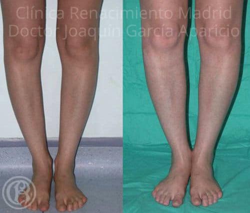 imagen de protesis de gemelos clinica renacimiento madrid