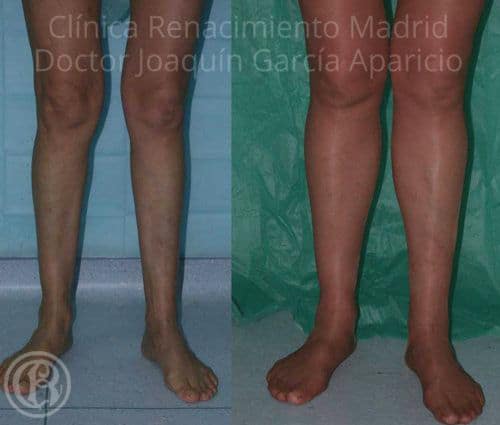 imagen de protesis de gemelos clinica renacimiento madrid