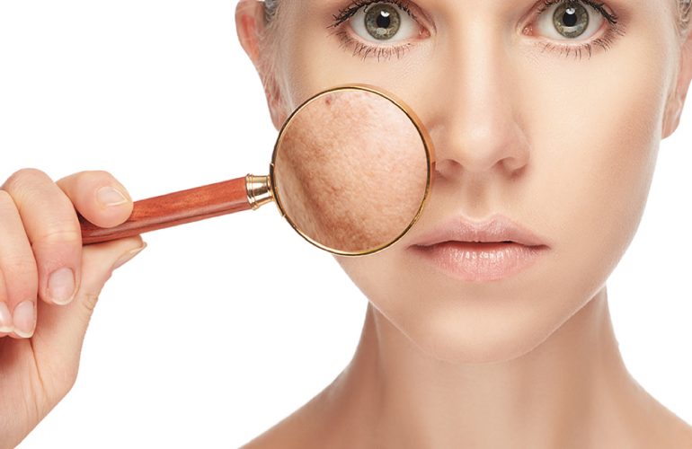 imagen de tratamiento de manchas clinica renacimiento madrid y marbella estetica facial