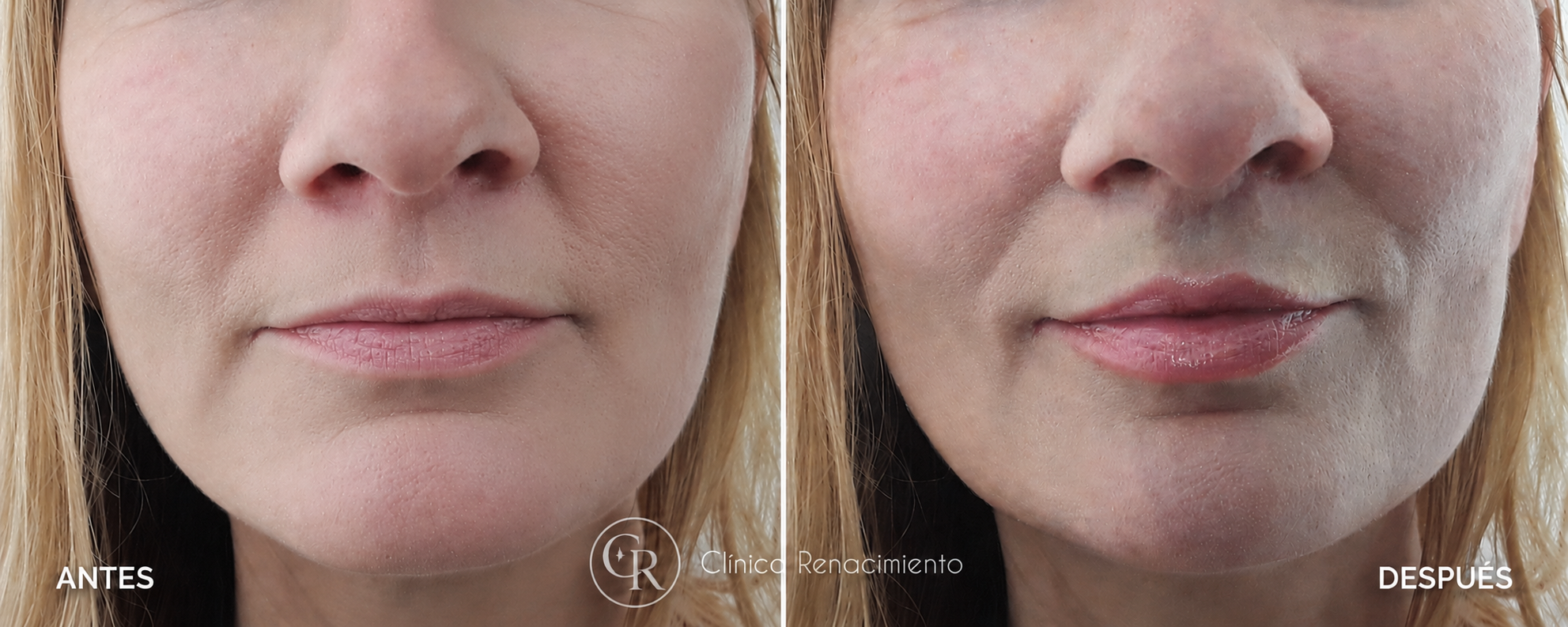 Caso real de lifting de labios antes y después Caso real de lifting de labios antes y después