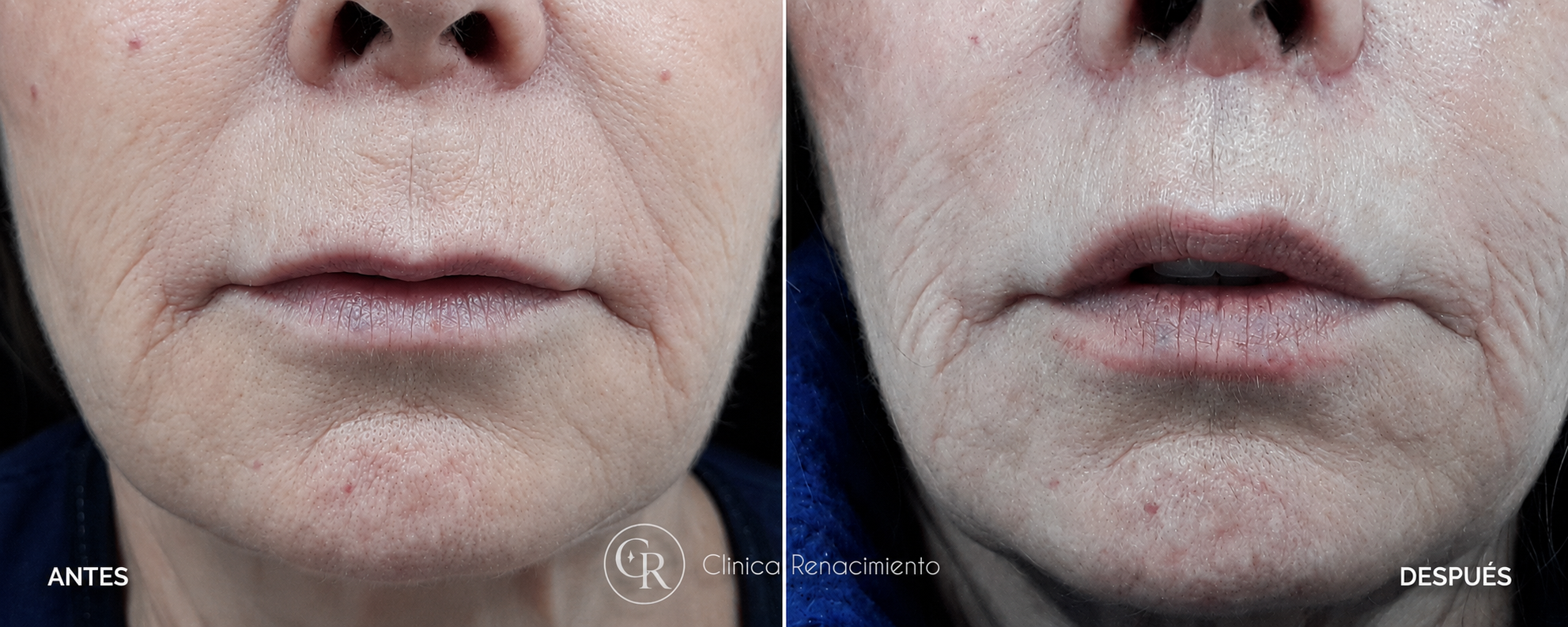 Caso real de lifting de labios antes y después 2 Caso real de lifting de labios antes y después 2