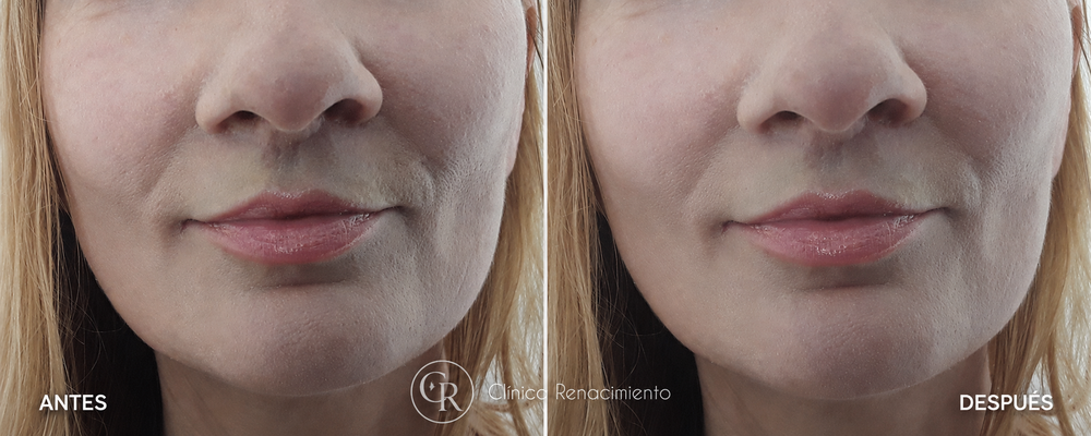 Caso real de lifting de labios antes y después