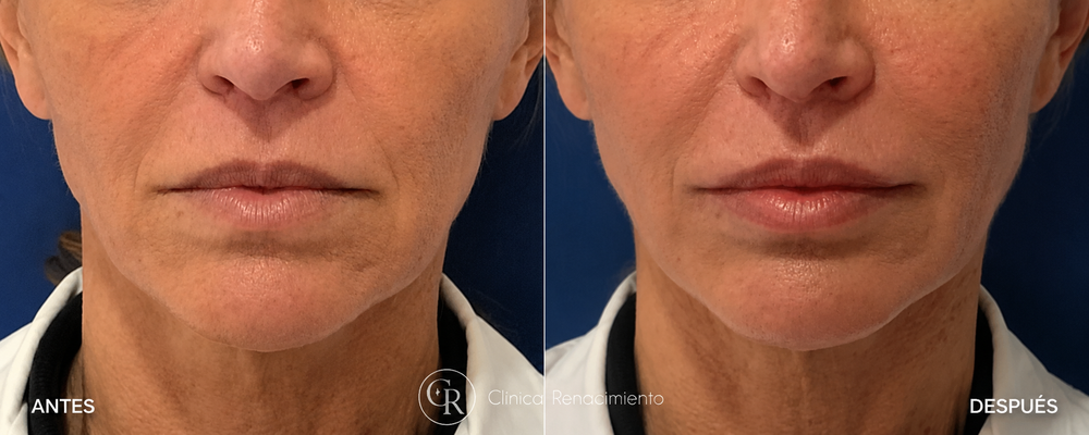 Antes y después lifting de labio superior