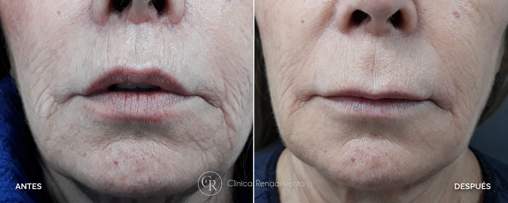 Caso real 3 lifting de labios antes y después