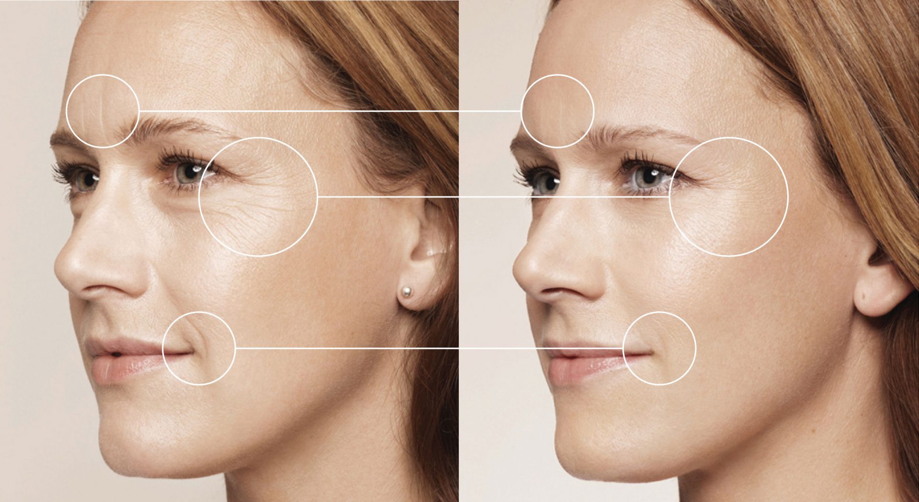 imagen de volumen-facial-clinica-renacimiento-madrid-marbella-scaled.jpg
